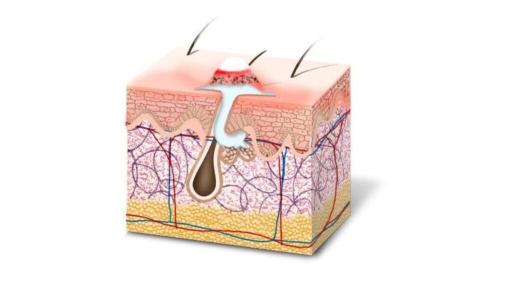 Painful nodules and cysts under the skin