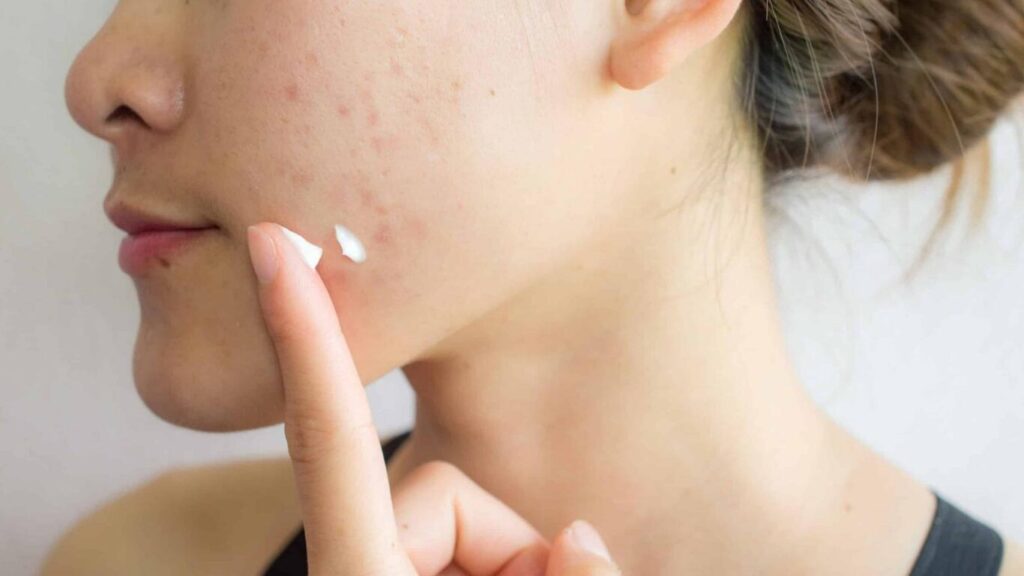 Woman applying facial cream to treat her acne scars