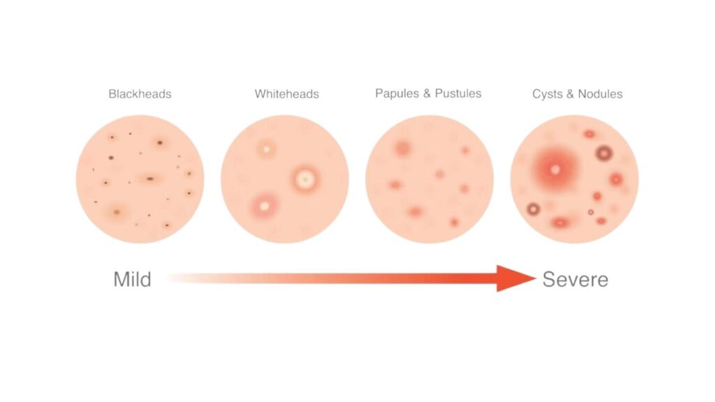 Acne development