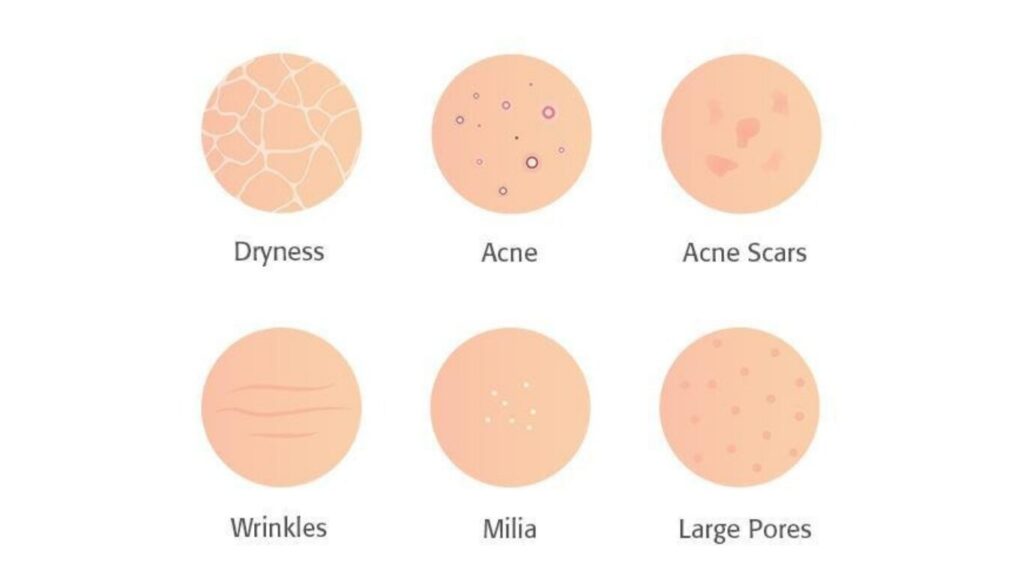 Scars affecting skin texture