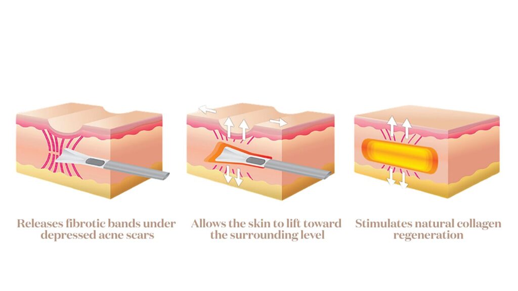 Subcision phases