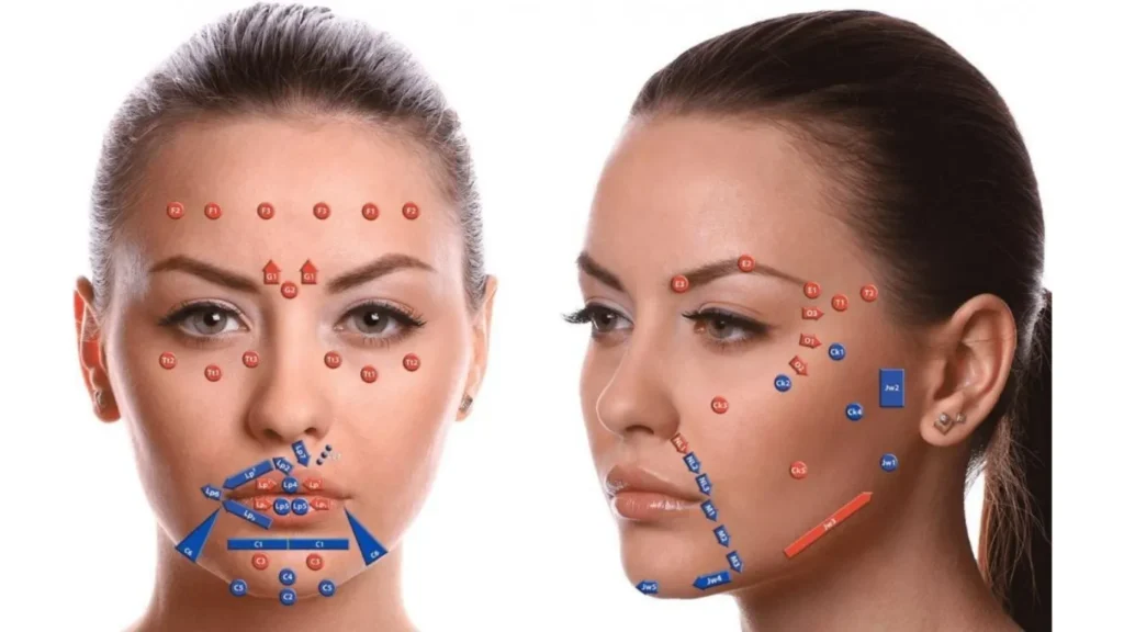 Areas of the face where Dermal Filling can be performed