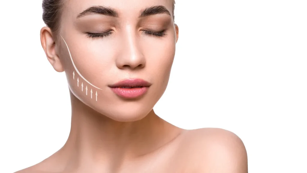 Face of a woman with arrows depicting where the facial lift will be performed